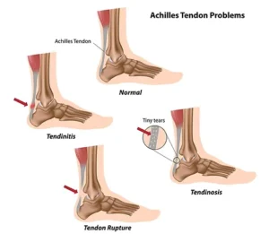 Achilles tendon problems