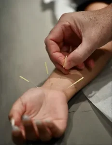 carpal tunnel acupuncture treatment