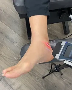 old ankle sprain acupuncture and laser therapy treatment