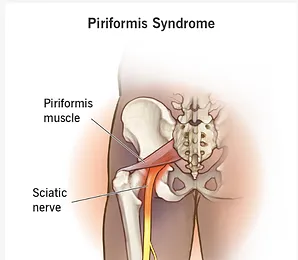 piriformis syndrome