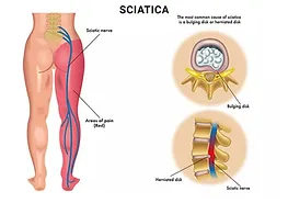 sciatica