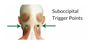 suboccipital trigger points