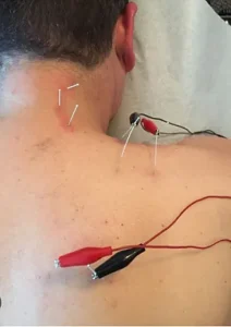 teres major minor needling