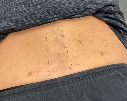 Acupuncture treatment being performed on back