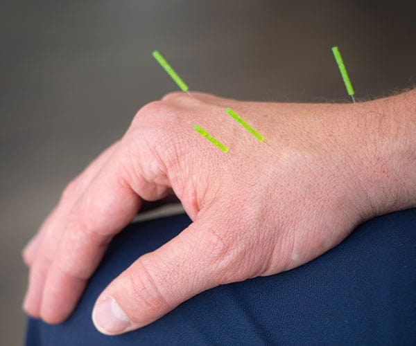 Acupuncture treatment picture