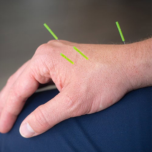 Acupuncture treatment being performed on patient in clinic