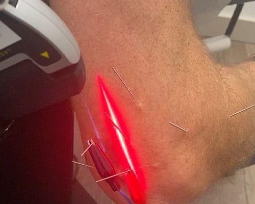 A patient receiving laser treatment in clinic for Knee pain